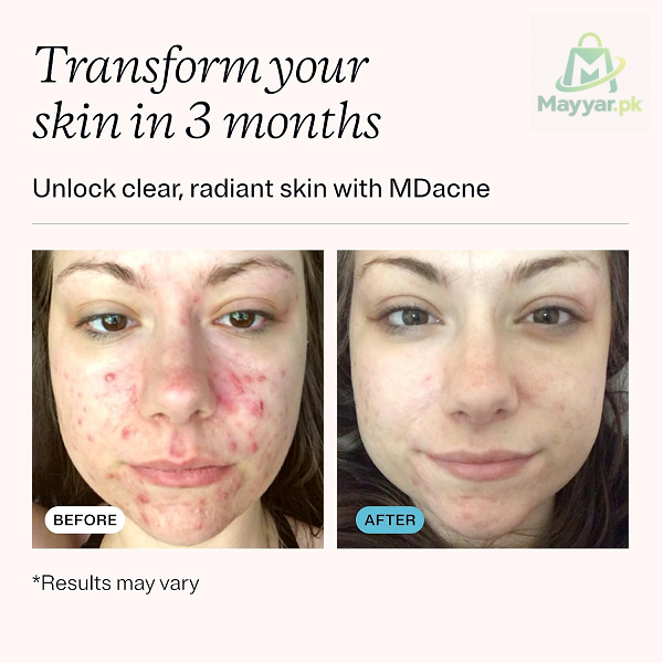 Benzoyl Peroxide 2.5% Treatment Cream thumbnail 2
